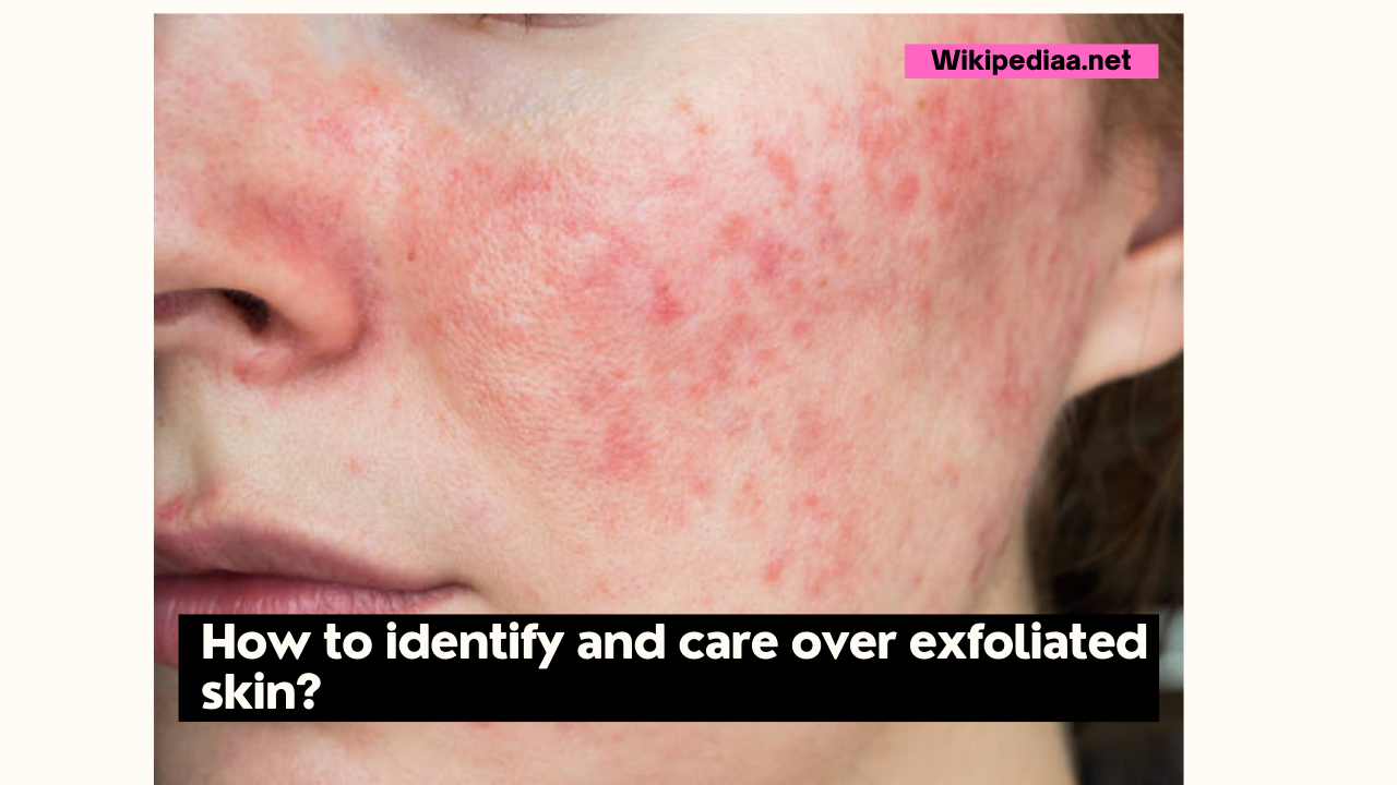 How to identify and care over exfoliated skin?