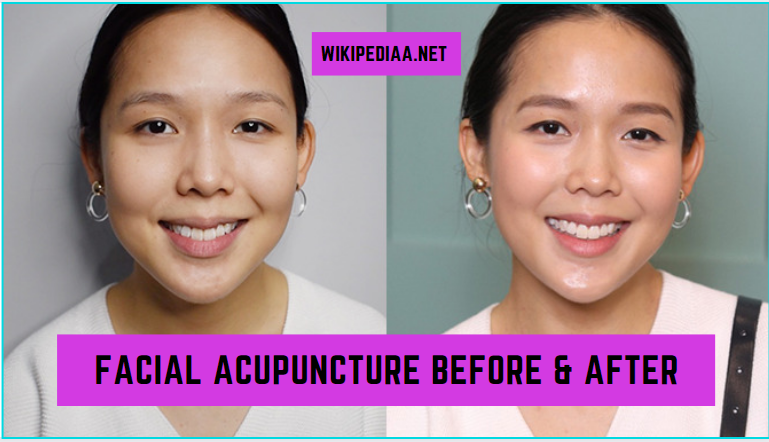 Facial Acupuncture Before & After